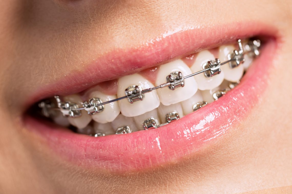 Invisible Braces – The Thatch Dental Practice in Mildenhall