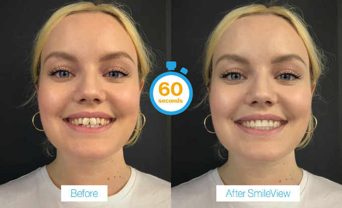 invisalign bury st edmunds