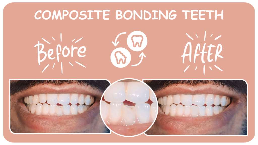 composite bonding teeth cost, composite bonding teeth cost in uk, composite bonding teeth cost in bury st edmunds, What is Composite Bonding Teeth in bury st edmunds, Composite Bonding Teeth in bury st edmunds, Composite Bonding in bury st edmunds, what is composite bonding on teeth, what is composite bonding on teeth in bury st edmunds, composite bonding near me, composite bonding near me bury st edmunds, composite bonding teeth near me bury st edmunds, composite bonding london, composite bonding price uk nhs, composite bonding before after, small teeth bonding before and after, composite bonding before and after, teeth bonding before and after, tooth gap filler, invisalign and composite bonding, composite bonding price uk, composite bonding uk price, can composite bonding be removed, whitening composite bonding, composite bonding aftercare, gap composite bonding, false front teeth, composite bonding teeth near me,