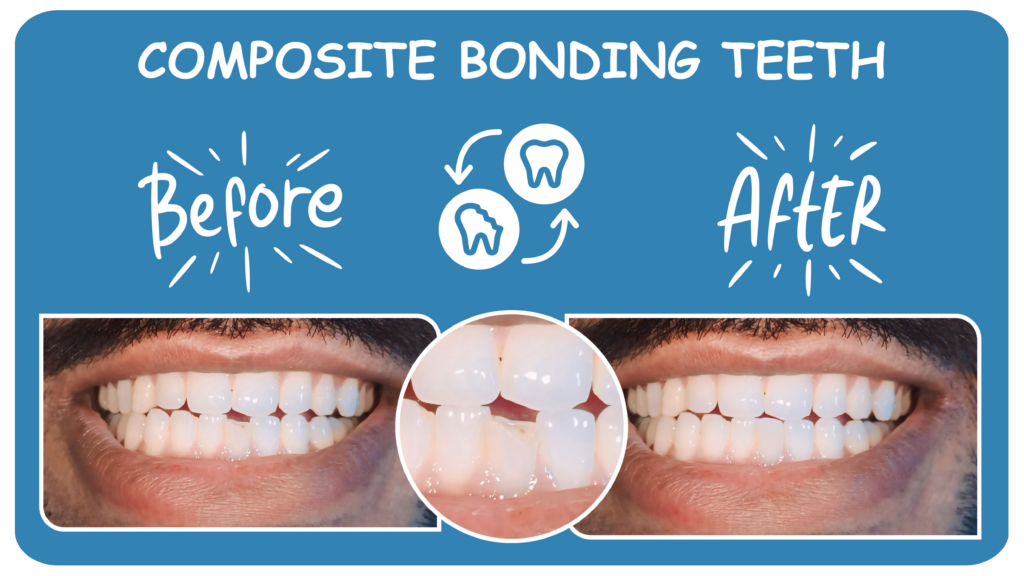 composite bonding teeth cost, composite bonding teeth cost in uk, composite bonding teeth cost in bury st edmunds, What is Composite Bonding Teeth in bury st edmunds, Composite Bonding Teeth in bury st edmunds, Composite Bonding in bury st edmunds, what is composite bonding on teeth, what is composite bonding on teeth in bury st edmunds, composite bonding near me, composite bonding near me bury st edmunds, composite bonding teeth near me bury st edmunds, composite bonding london, composite bonding price uk nhs, composite bonding before after, small teeth bonding before and after, composite bonding before and after, teeth bonding before and after, tooth gap filler, invisalign and composite bonding, composite bonding price uk, composite bonding uk price, can composite bonding be removed, whitening composite bonding, composite bonding aftercare, gap composite bonding, false front teeth, composite bonding teeth near me,